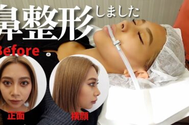 【鼻整形】あいみがコンプレックスを整形しました。