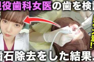 【歯石除去】現役歯科女医の歯周ポケットに隠れた歯石を取ったらどうなる？