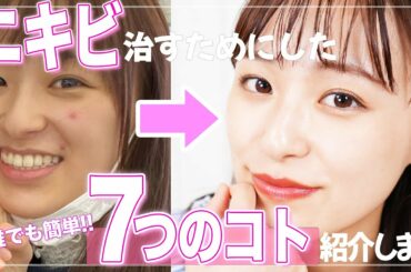 【私の実体験】酷いニキビも簡単に治した７つの方法✨思春期ニキビやっつけよう！