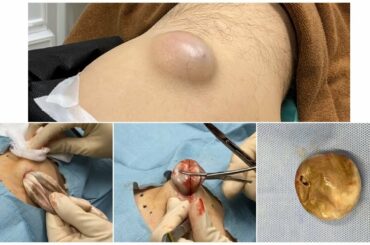 ふるばやし形成外科粉瘤クリニック　ブログでも詳しく解説してます。　東京新宿院　大腿部の粉瘤　くりぬき法　大阪梅田形成外科クリニック