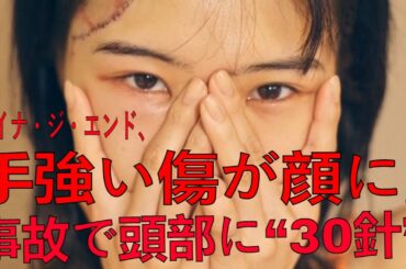 手強い傷が顔に」　アイナ・ジ・エンド、事故で頭部に“30針”　血が止まらず救急車内で「死にたくない」| 最新ニュース | セレブニュース | ニュース企画 #アイナ・ジ・エンド