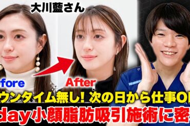 大川藍さんの顔の脂肪吸引をしたら変化がすごすぎた! 【1day小顔脂肪吸引/ACLINIC】
