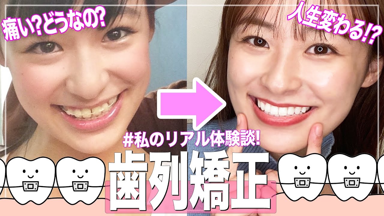 【歯列矯正】歯並び良くなかった私がワイヤー矯正したらこうなった🦷!全て話します! 【歯列矯正】歯並び良くなかった私がワイヤー矯正したらこうなった🦷!全て話します!