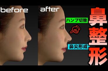 やっと、念願の鼻整形へ
