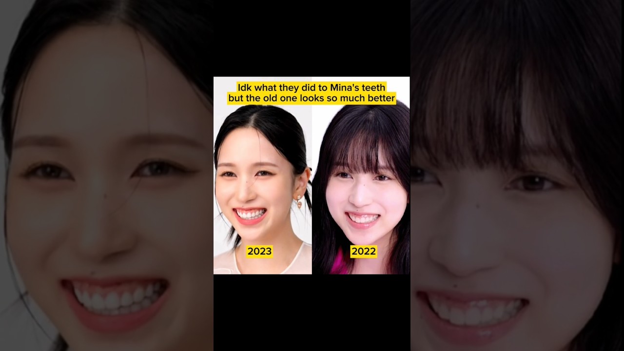 MINA NEW SMILE WITH VENEERS? what do you think? #mina #veneers #