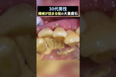 機械が詰まってしまう程の大量歯石 #歯医者 #歯石除去 #ザホワイトデンタルクリニック