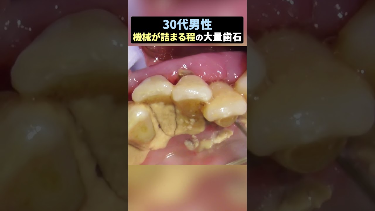 機械が詰まってしまう程の大量歯石 #歯医者 #歯石除去 #ザホワイトデンタルクリニック 機械が詰まってしまう程の大量歯石 #歯医者 #歯石除去 #ザホワイトデンタルクリニック