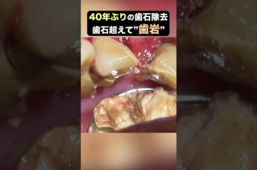 【TarTar】歯石超えて"歯岩"なんですけど！？！？ #歯石除去 #ザホワイトデンタルクリニック #歯医者