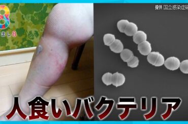 【致死率30%】人食いバクテリア過去最多に ８年前に感染し右脚を失った女性が語る恐怖【めざまし８ニュース】
