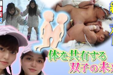 まさに奇跡の生活を送る双子【ザ！世界仰天ニュース】
