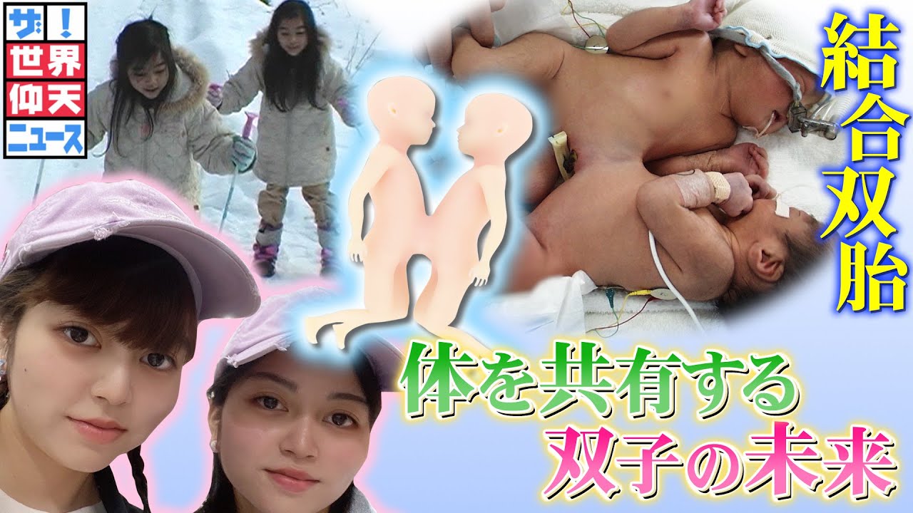 まさに奇跡の生活を送る双子【ザ!世界仰天ニュース】 Moe Zine
