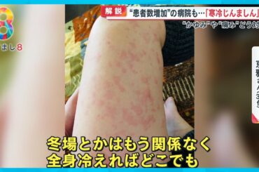 「寒冷じんましん」って？ 女性に多く突然発症し放置すると慢性化のリスクも…【めざまし８ニュース】