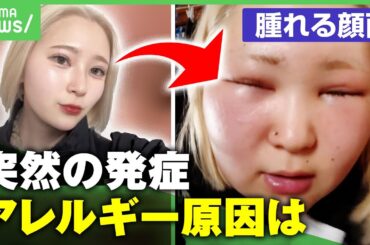 【ブリーチアレルギー】人気TikTokerを襲った"顔の腫れとかゆみ" ヘアカラーで突然発症…進行すると呼吸器症状や嘔吐も｜アベヒル