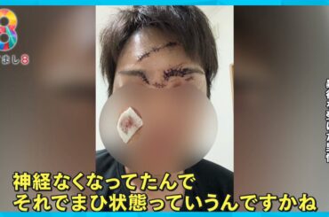 【独自】榊原容疑者に酒瓶で突然殴られ20針…被害者告白 元交際相手も語る“凶暴性”【めざまし８ニュース】