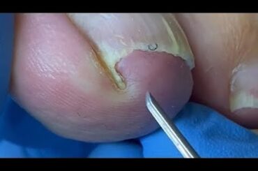 Pulling out huge nails and crazily filling the nail grooves【Pedicure Master Lin Jun】