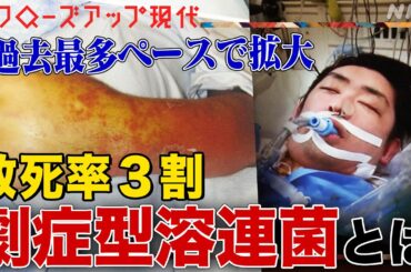 【致死率3割】「劇症型溶連菌」が過去最多ペースで拡大 感染経路は？毒性が強い"M1UK株"とは？容体急変し手足の切断に至ることも(語り:小松未可子)【クロ現】| NHK