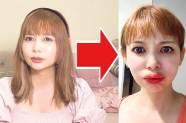 くちびるが5倍に腫れた。