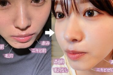 ニキビ肌からトラブルなしの肌になった私の肌管理について話します🩵（ スキンケア 美肌施術 肌質改善 垢抜け ）