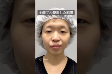 【全顔フル整形】整形で別人級の垢抜け顔に！#shorts