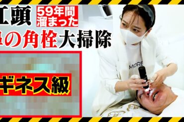 【いちご鼻】59年間放置した江頭のブラックヘッドを毛穴洗浄したらチンアナゴが出てきた