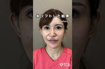 【糸リフト】糸リフトした結果…#shorts