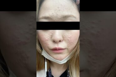 1ヶ月でニキビ肌を治した方法