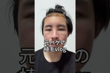 元ハゲの植毛vlog 質問があれば回答するのでお気軽にコメントください☺︎ #整形 #美容整形 #垢抜け #垢抜け方法 #ビフォーアフター #ハゲ #植毛 #育毛 #トルコ