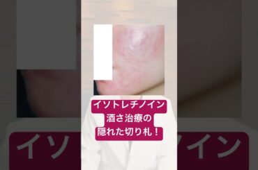 赤ら顔にニキビ薬!? 🤔 酒さに効く意外な薬の正体【#酒さ #赤ら顔】