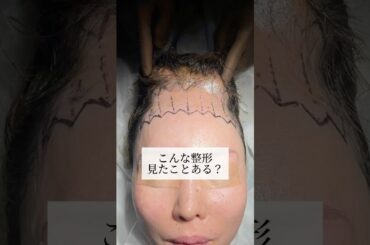 【整形】こんな整形みたことある？#shorts