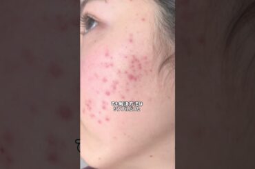 ニキビ撲滅計画に終止符😌 #スキンケア #ニキビ #クレンジング #美容 #ニキビケア #pr