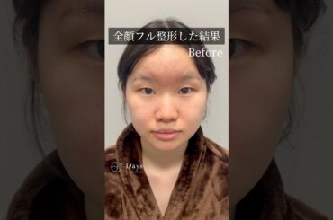【全顔整形】ナチュラルに垢抜けた！#shorts