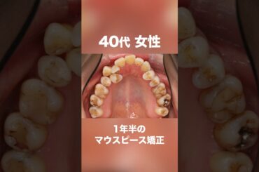 ワイヤーではなくマウスピース矯正で治したい方必見#shorts #矯正#歯列矯正#マウスピース #マウスピース矯正#歯並び #インビザライン