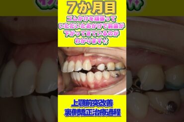 【裏側矯正症例】出っ歯を治したい！#歯列矯正 #矯正歯科 #出っ歯