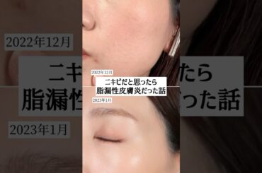 【ニキビだと思ったら脂漏性皮膚炎だった話】#脂漏性皮膚炎 #ニキビ #ニキビ改善 #吹き出物