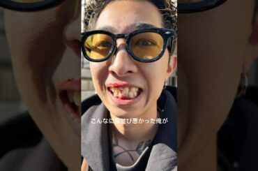 矯正始めて1年の現実がこれ。 📍キーデンタルクリニック-赤坂                                #歯科矯正 #歯列矯正 #美容男子  #美容 #口ゴボ #矯正