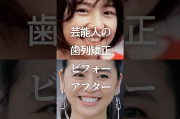 芸能人の歯列矯正ビフォーアフターPart3　#ガルちゃん #芸能人 #歯列矯正