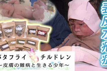 “皮膚の難病”と生きる少年　見えてきた「希望」と「夢」（声：平手友梨奈）【ザ・ドキュメンタリー「バタフライチルドレン」】