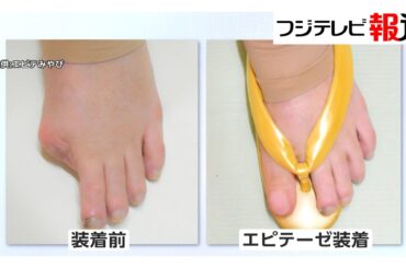 外見に「自信」取り戻し、憧れの結婚指輪写真も…「エピテーゼ」制作現場を山﨑夕貴キャスターが取材（2026年03月31日）