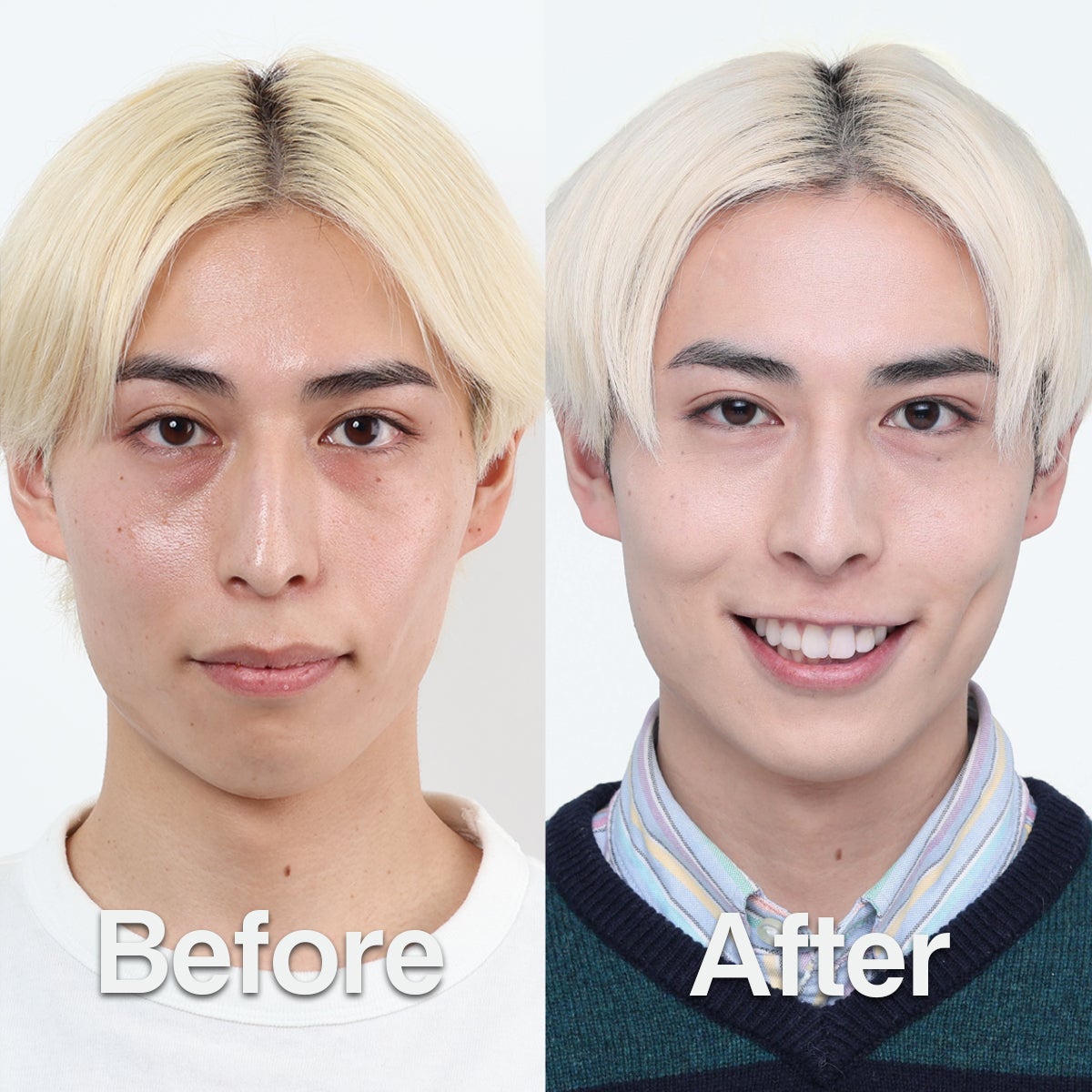 メンズスキンケアブランドDISM　ぷだおくんのビフォー・アフター