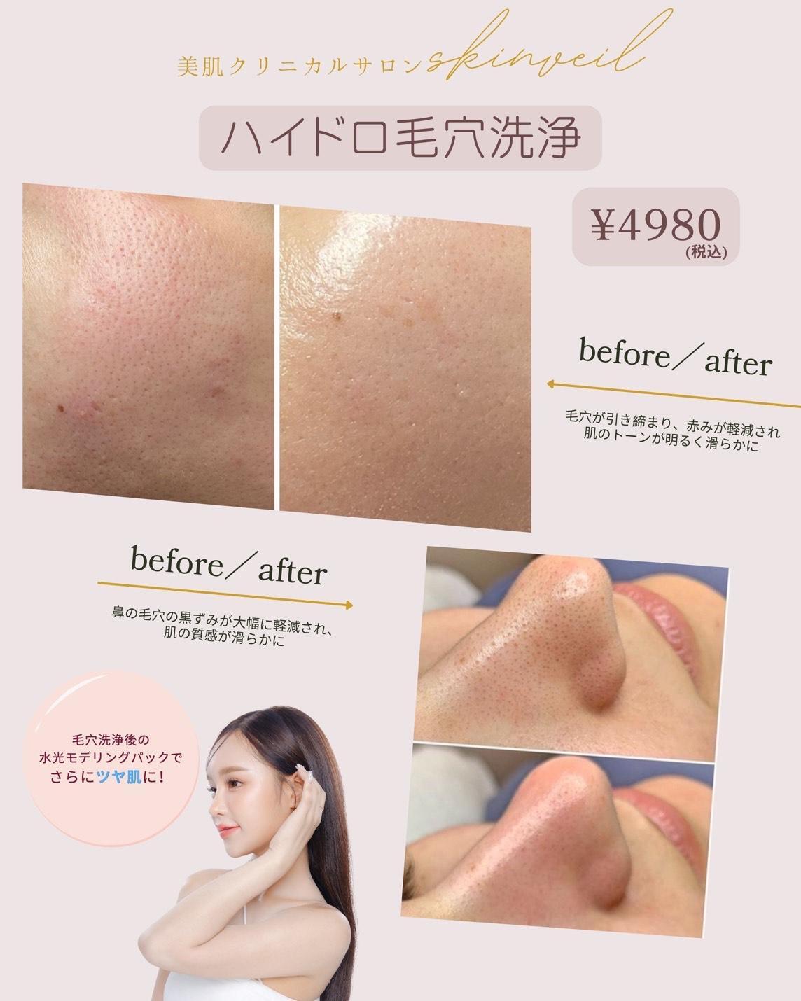 ハイドロ毛穴洗浄
