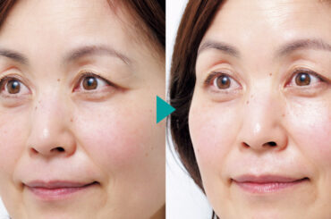 55歳が驚いた！「肌のキメが20％アップ」乾燥・老け見えをリセットする最新導入治療 | 美ST ONLINE