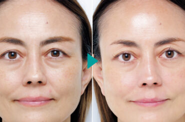 47歳が実感！1週間で「キメが10％UP」した、話題の肌育注射“BABY GLOW”の正体 | 美ST ONLINE